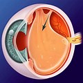 Posterior Vitreous Detachment Retinal Tear