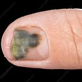 Pseudomonas Bacterial Nail Infection