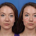 Round Face Surgery Before and After