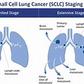 Small Cell Lung Cancer Journal