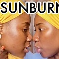 SunBurn On Black People
