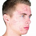 Teenage Skin Problems Images
