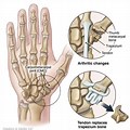 Thumb Carpometacarpal Tendon Arthroplasty