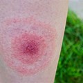 Tick Lyme Disease Rash