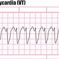 Ventricular Tachycardia Heart Rhythm
