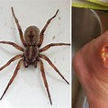 Widow Brown Recluse Spider Bite