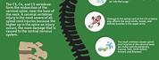 C5 Spinal Cord Injury