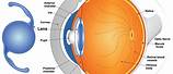 Cataract Surgery Intraocular Lens
