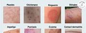 Different Kinds of Skin Rashes