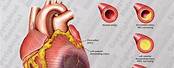 Myocardial Infraction Pic