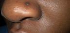 Nose Piercing Scar Tissue