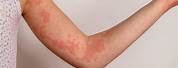 Rash Urticaria Allergic Reaction