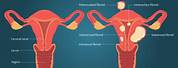 USS Features of Uterine Fibroid