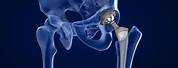What Does Whole Hip-Replacement Look Like