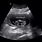 14 Week Baby Ultrasound
