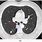 2 Cm Nodule On Lung