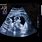 4 Months Pregnant Ultrasound Twins