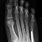 5th Metatarsal Neck Fracture