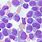 Acute Myeloid Leukemia Bone Marrow