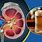 Alcoholic Kidney