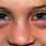Allergic Reaction Eyes Swollen