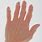 Arthritis Bumps On Fingers