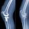 Arthritis Knee Surgery