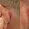 Basal Cell Carcinoma Behind Ear