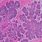 Basal Cell Carcinoma Microscope
