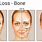 Bone Loss Face
