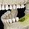 Bone Loss in Jaw