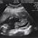 Boy Ultrasound 11 Weeks