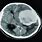 Brain Lesion CT Scan
