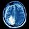 Brain Tumor X-ray