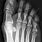 Broken Big Toe X-ray