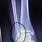 Broken Fibula at Ankle