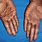 Capecitabine Hand Foot Syndrome