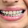 Clear Metal Braces