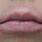 Contact Dermatitis On Lips Pictures