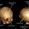 Coronal Suture Craniosynostosis