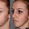 Cosmetic Jaw Surgery