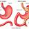 Distal Gastric Bypass