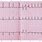 EKG T Wave Abnormalities