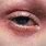 Eczema On Eyes