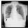 Enlarged Heart Chest X-ray