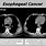 Esophageal Cancer CT