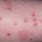 Flea Bites On Human Skin