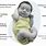 Galactosemia Baby