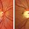 Glaucomatous Optic Disc