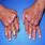 Hands with Rheumatoid Arthritis